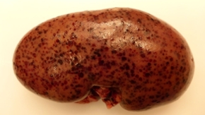 Foto einer Niere mit schwarzen Flecken.