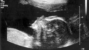 Der Ausdruck eines Ultraschallbildes. Die Silhouette eines Kinderkopfes ist zu erkennen. 